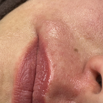 Після процедури