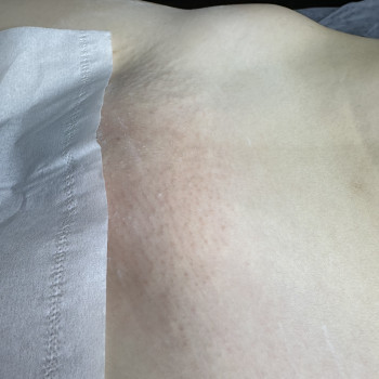 Бікіні одразу після процедури