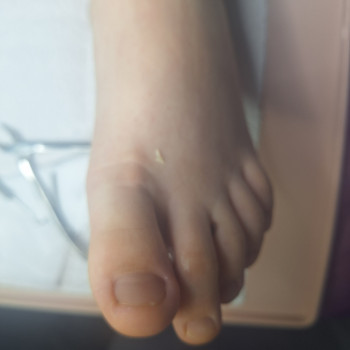 Дитина,8 років.
Мама не правильно підрізала дліну нігтя.
Створився гострий кут та почалося запален...