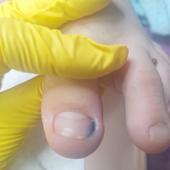 Після зняття запалення та вилалення кута-поставили жидку тампонаду