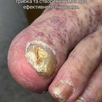 Фото з портфоліо фахівця Олена Шибанова (подолог, Черкаси)