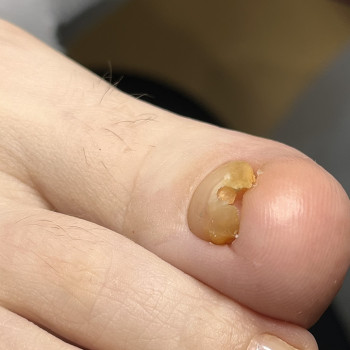 Фото з портфоліо фахівця Олена Шибанова (подолог, Черкаси)