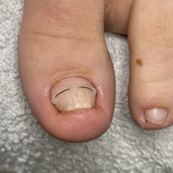 Фото з портфоліо фахівця Олена Шибанова (подолог, Черкаси)