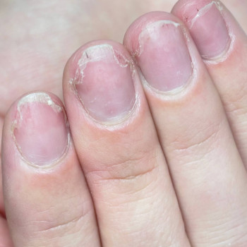 Фото з портфоліо фахівця Олена Шибанова (подолог, Черкаси)