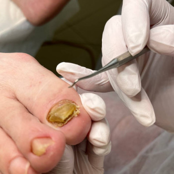 Фото з портфоліо фахівця Олена Шибанова (подолог, Черкаси)