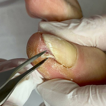 Фото з портфоліо фахівця Олена Шибанова (подолог, Черкаси)