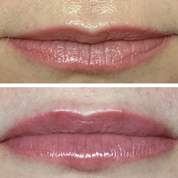 Легка корекція губ без надмірного ефекту