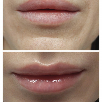 Легка корекція губ без надмірного ефекту