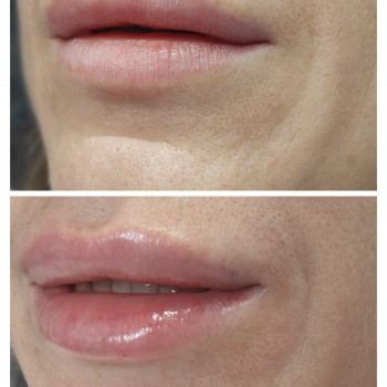 Легка корекція губ без надмірного ефекту