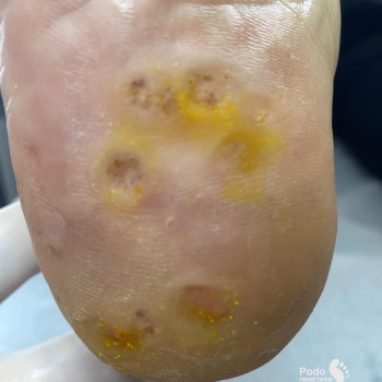 Видалення бородавки на стопі ВПЛ ДО/