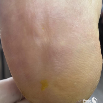 Видалення бородовки на стопі ПІСЛЯ/