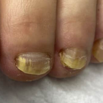 Грибок нігтів
Оніхомікоз нігтів