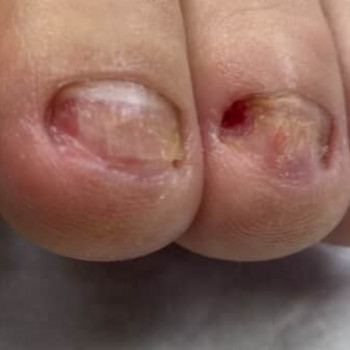 Подологічна зачистка нігтів при ураженні грибком