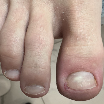 Через 5днів після виконання рекомендацій подолога при врослому нігті