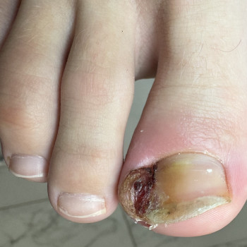 Врослий ніготь