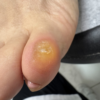 Мозоль стирневий ,дуже болючий