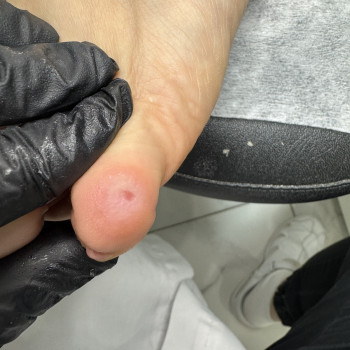 Після видалення стрижневого мозоля,безболісно та швидко.