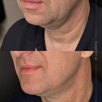 робота з нижньою третиною обличчя