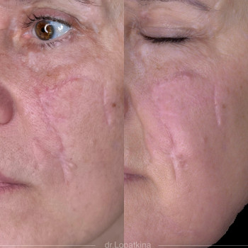 корекція шрамів після мино-вибухової травми