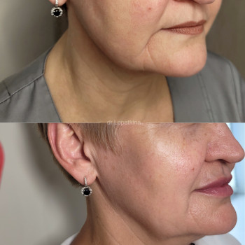 Корекція брил