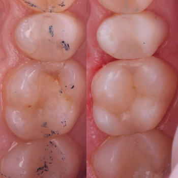 До/після 
Лікування вторинного карієсу