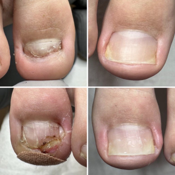 Оніхокриптоз (врослий ніготь)
                    Подолог Лілія Черкассы