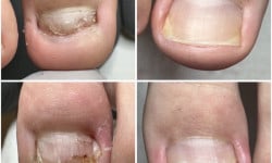 Оніхокриптоз (врослий ніготь) Подолог Лілія Черкассы