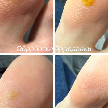 Обработка подошвенной бородавки