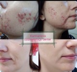 МЕЗОБОТОКС «КОКТЕЙЛЬ МОНАКО» Дерматолог косметолог Нелли Киев