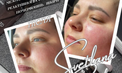 Мезотерапія для чутливої шкіри INNO-TDS® Sensitive-ID Косметолог-эстетист Светлана Харьков