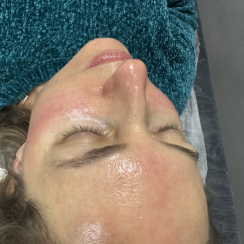 Мікронідлінг обличчя
                    Косметолог  Борисполь