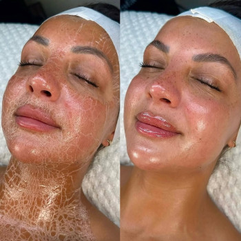 Ферментотерапія
                    Косметолог  Бориспіль