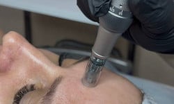 Омолодження шкіри Косметолог Юлия Черкассы