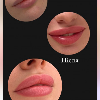 До 
Після 
Загоєння 
Естетичний перманентний макіяж губ
