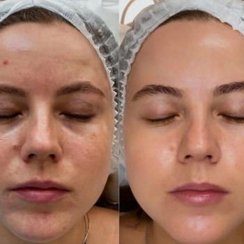 Гідропілінг обличчя та тіла
                    Косметолог Елена Одеса