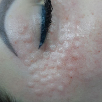 Біоревіталізація зони навколо очей
                    Косметолог Анастасия Днепр