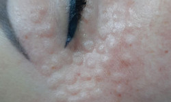 Біоревіталізація зони навколо очей Косметолог Анастасия Днепр