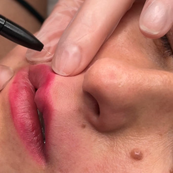 Електроепіляція обличчя