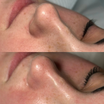 Комбінована чистка обличчя
                    Косметолог-естетист  Черкаси