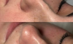 Комбінована чистка обличчя Косметолог-естетист  Черкаси