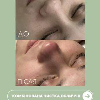 Комбінована чистка обличчя
                    Косметолог-естетист  Черкаси