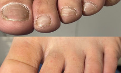 Видалення врослого нігтя Подолог Алина Мукачево