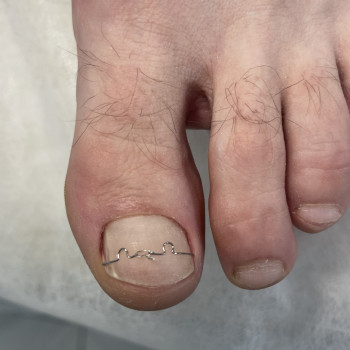 Встановлена корекційна система 3ТО для лікування врослого нігтя. Подолог, Мукачево.