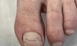 Встановлення титанової нитки, корекційна система 3ТО Подолог Алина Мукачево