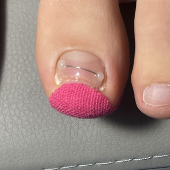 Встановлення титанової нитки для лікування врослого нігтя.Подолог,Мукачево