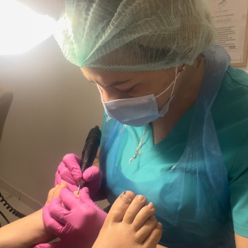 Встановлення титанової нитки для лікування врослого нігтя. Подолог, Мукачево.