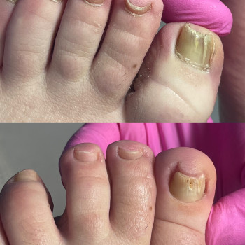 Комплексна обробка нігтів і шкіри стоп при грибкових ураженнях. Механічне очищення, зменшення уражен...