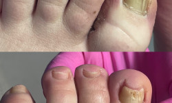 Лікування грибкових уражень нігтів та шкіри стоп Подолог Алина Мукачево