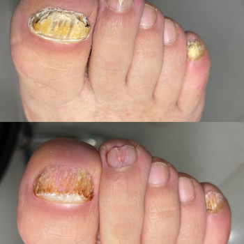 Комплексна обробка нігтів і шкіри стоп при грибкових ураженнях. Механічне очищення, зменшення уражен...