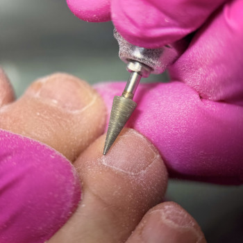 Медичний педикюр у подолога в Мукачеві. Робота з проблемними стопами та нігтями без покриття.